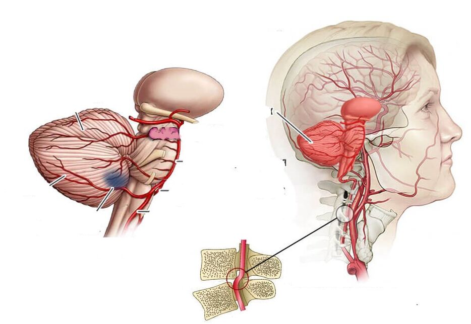 Isquemia cerebelar
